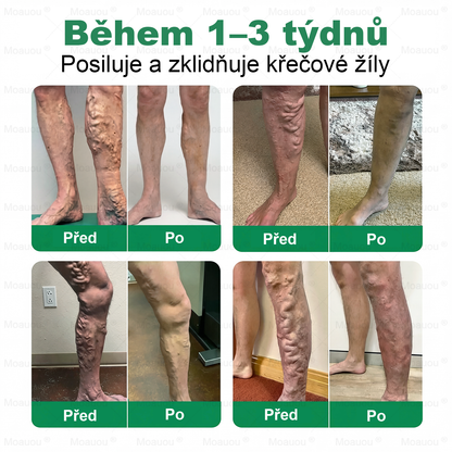 🌿Moauou® Mikrojehličková náplast pro péči o křečové žíly ✅Cílená péče pro unavené a těžké nohy s pocitem pnutí ⚡VELKÁ AKCE!