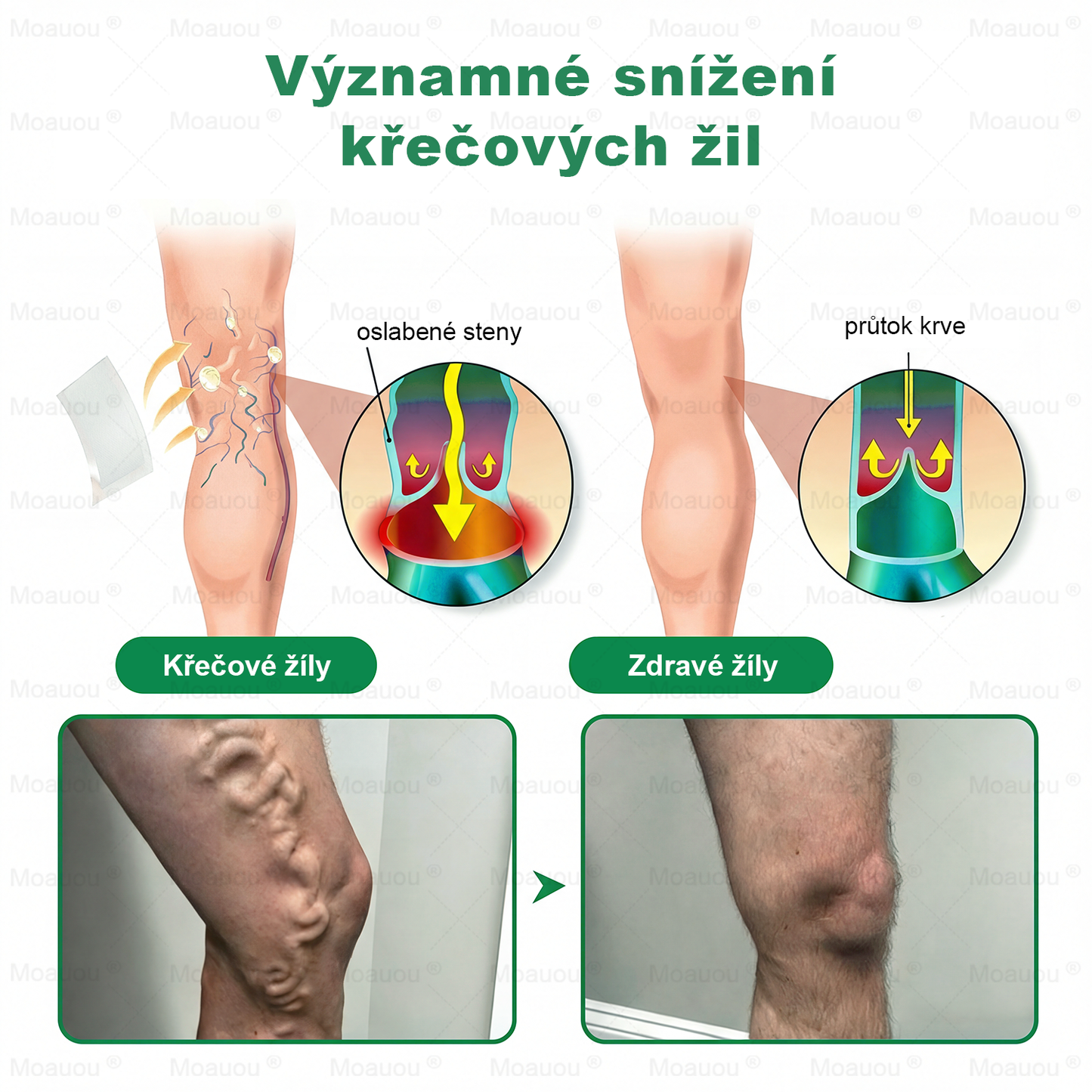🌿Moauou® Mikrojehličková náplast pro péči o křečové žíly ✅Cílená péče pro unavené a těžké nohy s pocitem pnutí ⚡VELKÁ AKCE!